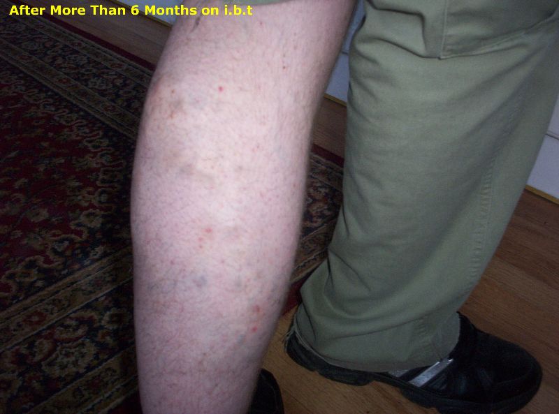 Male 34 Varicose Vein showing huge improvements after 6 months of inclined therapy